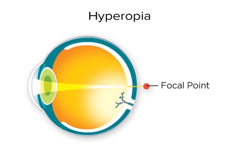 Image result for Hyperopia