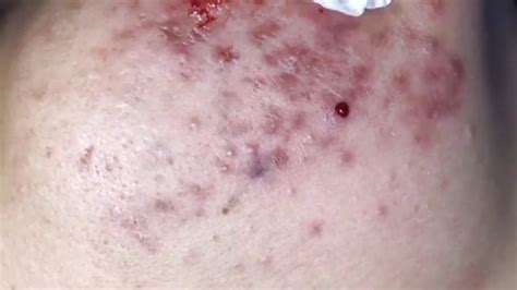Cystic Blackheads に対する画像結果