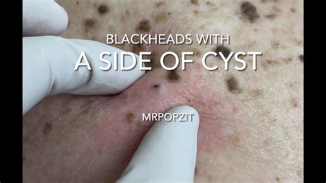 Cystic Blackheads に対する画像結果