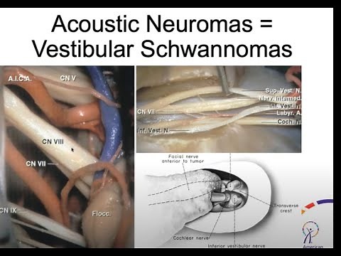 A Rare Brain Tumor Affecting Hearing & Balance - Acoustic Neuroma