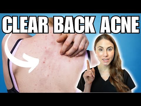 Clearing Back Acne: Expert Tips And Tricks