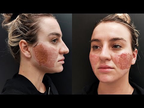 Acne Scar Removal with CO2 Laser Treatment - Before & After
