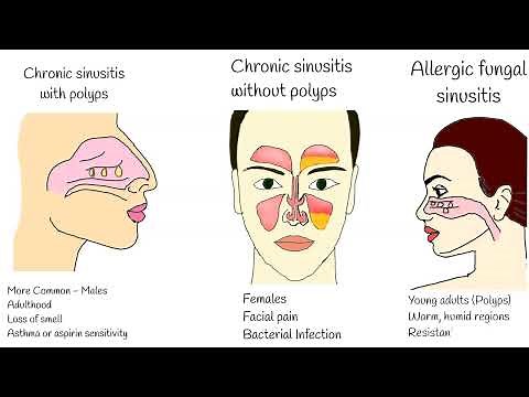 Chronic Sinusitis - Symptoms, causes and treatment. Sinusitis with polyps, Fungal sinusitis