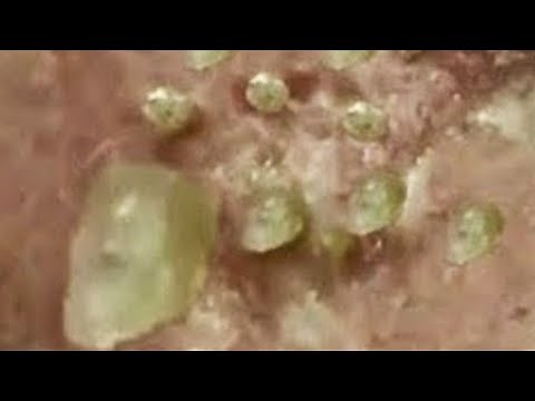 Deep blackhead extraction Cystic acne & pimple popping #19