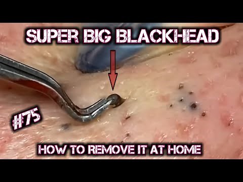 Satisfying Videos | Pimples Popping - Blackheads - Acne & Cysts Compilation #75