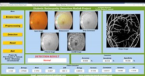 Diabetic Retinopathy Detection Using Image Processing Matlab Project Code | Final Year Project