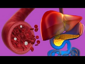 Hypoglycemia Without Diabetes: Causes And Symptoms