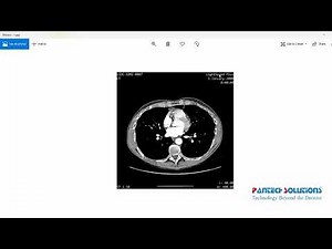 Lung Cancer Detection Using Deep Learning Matlab